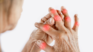 supplements for arthritis