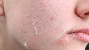 best vitamins for dry aging skin