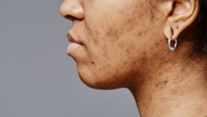 Hormonal Acne Treatment