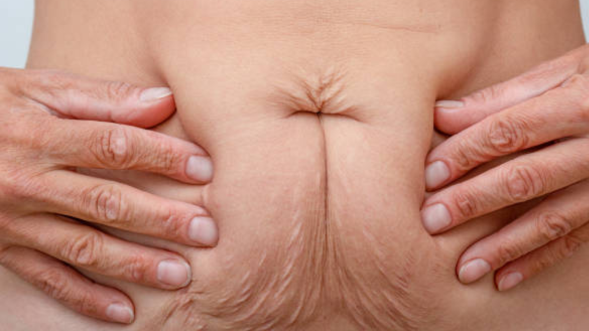 Cortisol and Weight Gain in Women The Stress-Fat Connection &; How to Fix It