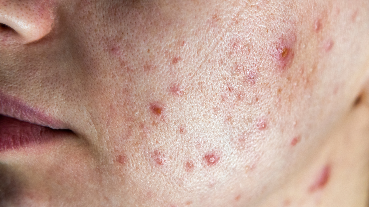 Zinc for Hormonal Acne How It Works & The Best Supplements