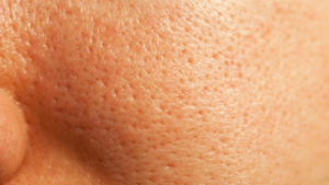 Skin Barrier Repair