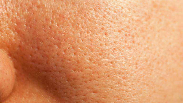 Skin Barrier Repair