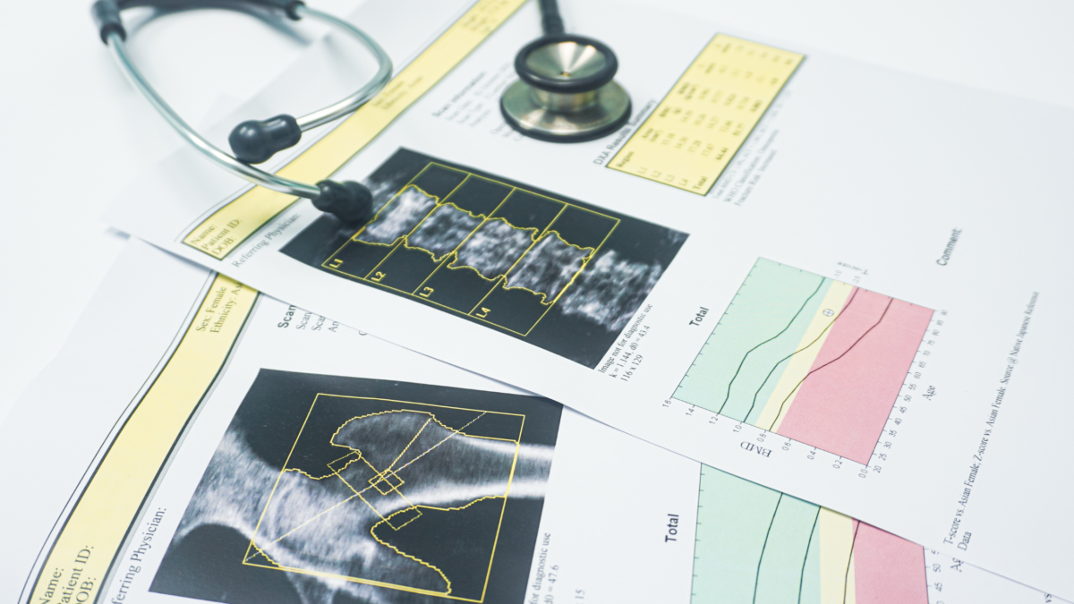 Bone Density After Menopause