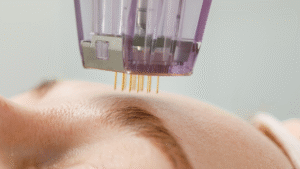 calecim professional treatment